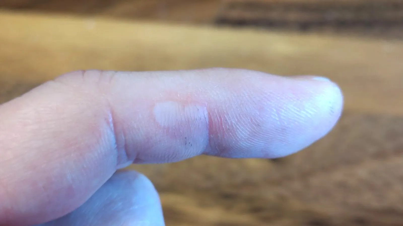 Blistered finger.